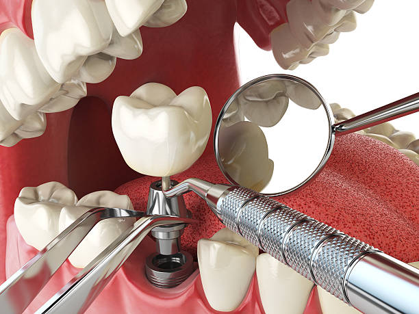 Best Emergency Dental Care for Sports Injuries in Balm, FL